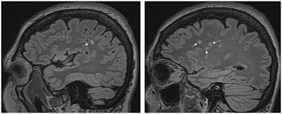 The volume of the thalamus and hippocampus in a right-handed female episodic migraine group